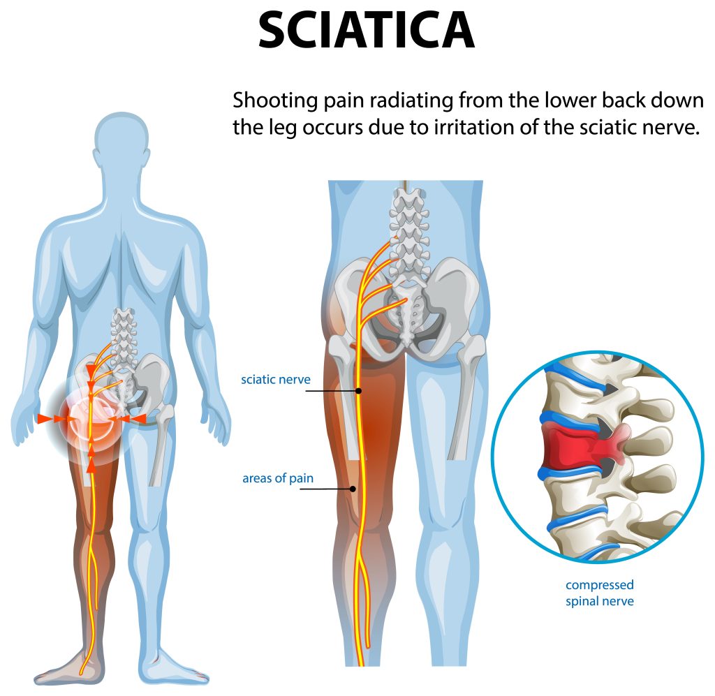 Sciatica nerve anatomy diagram